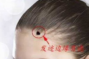 頭發邊緣有痣代表什么,發際線上有痣命運如何 頭發邊緣有痣代表什么,發際線上有痣命運如何