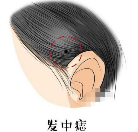 女人發中長痣代表什么