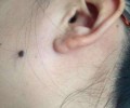 痣上長(zhǎng)毛有福是真的嗎？